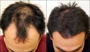Generalité sur le minoxidil 5 %